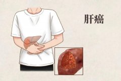 乙肝与肝癌